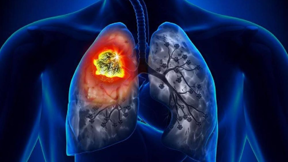 Bu faktörler Akciğer Kanseri riskini artırıyor