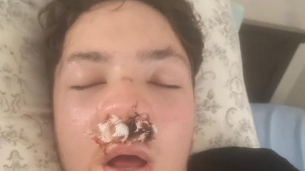 Liselilerin kavgasında 14 yaşında ki çocuğun burnu  kırıldı