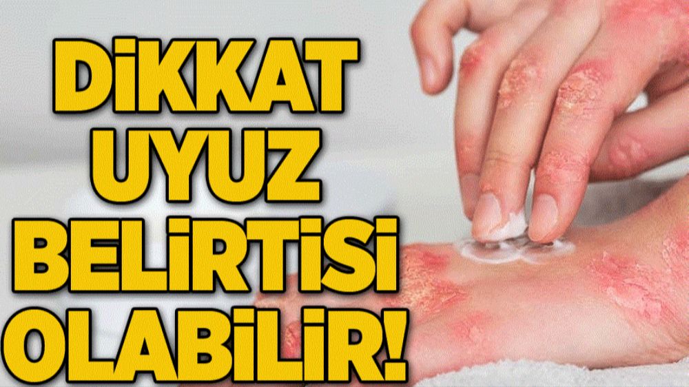 Uyuz Belirtileri ve Semptomları: Türkiye'de Uyuz Vakalarındaki Artışa Dikkat!