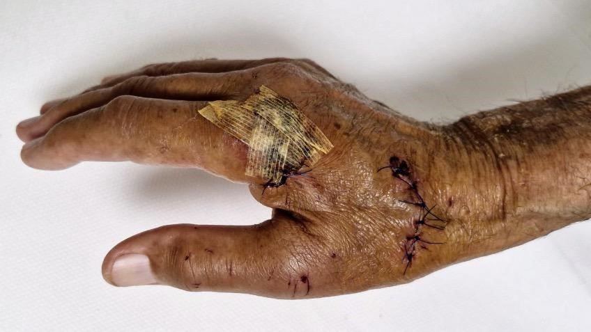 Antalya'da duşa kabin patladı, eline 20'ye yakın dikiş atıldı