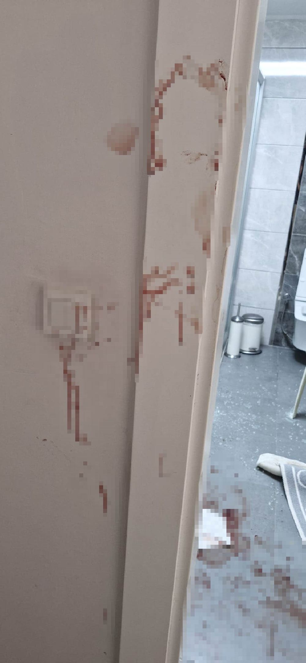 Antalya'da duşa kabin patladı, eline 20'ye yakın dikiş atıldı