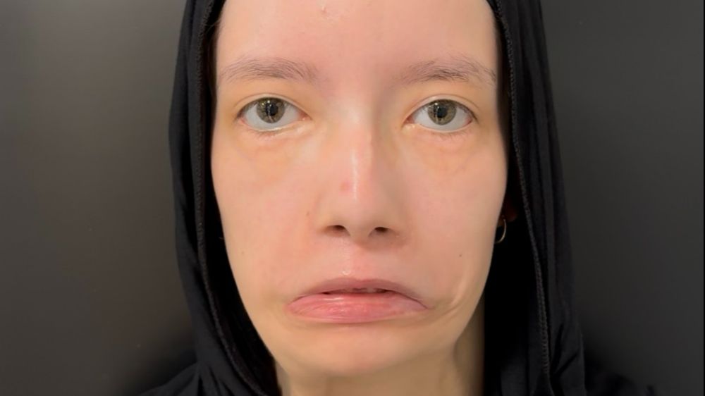 Doğuştan mimiklerini kullanamıyordu, 23 yıl sonra ilk kez gülümsedi: "Ülkemizde bir ilk olma özelliği taşıyor"