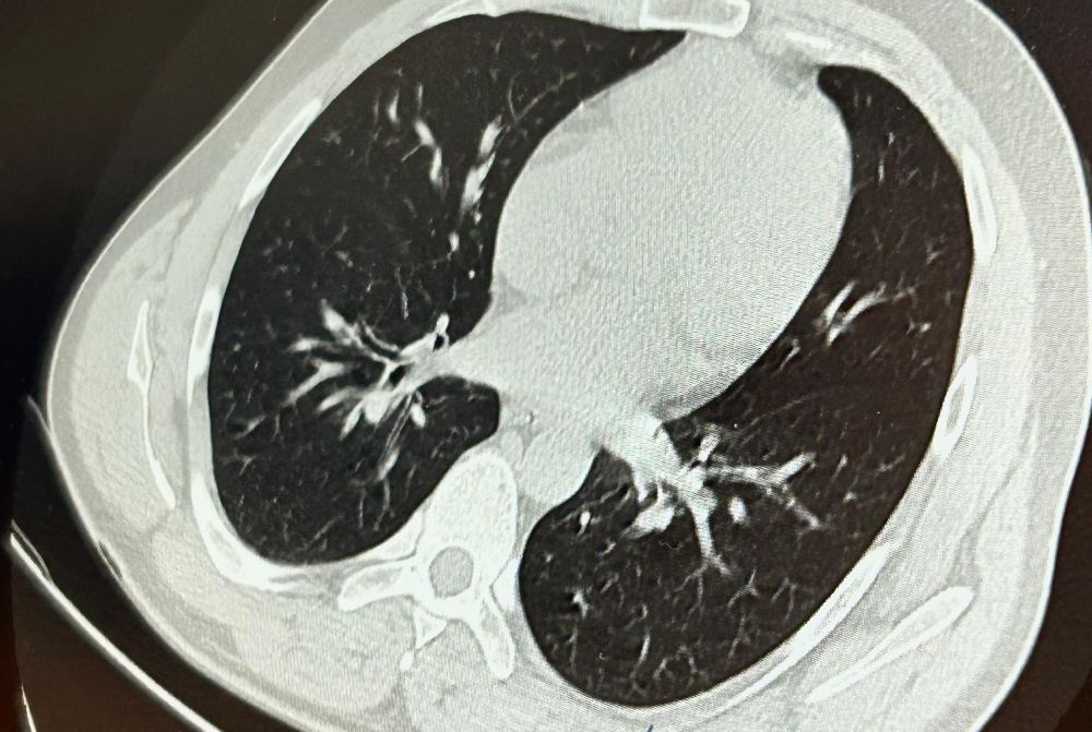 İmplant vidası ciğerine kaçan hasta ölümden döndü