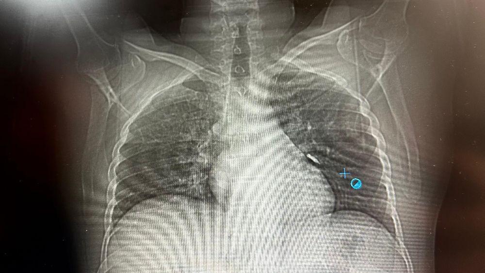 İmplant vidası ciğerine kaçan hasta ölümden döndü