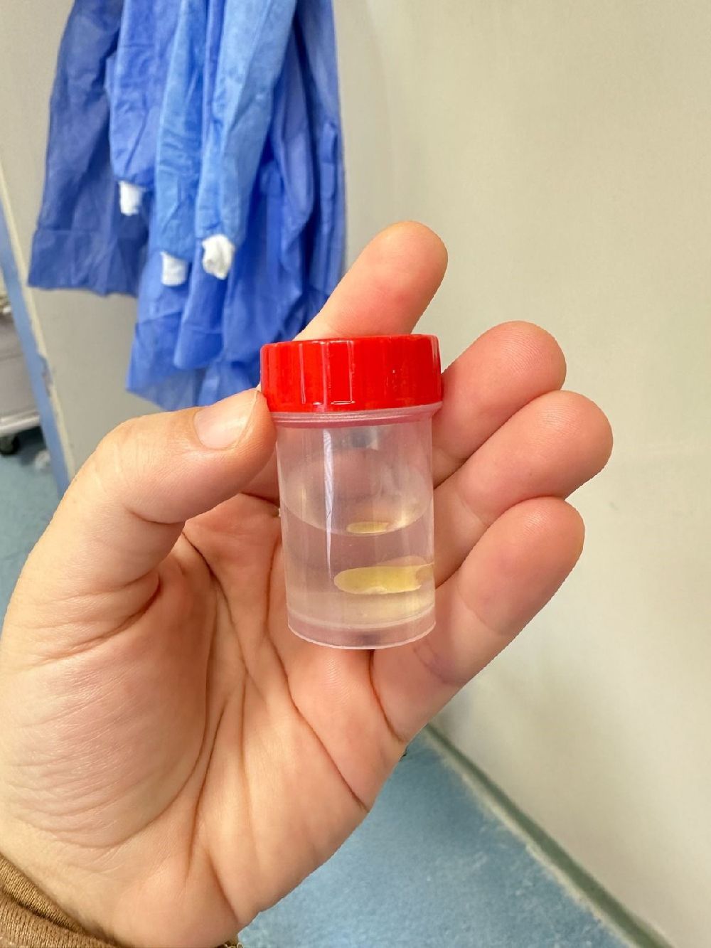 Nefes borusuna kaçan mısır tanesi 5 ay sonra ortaya çıktı