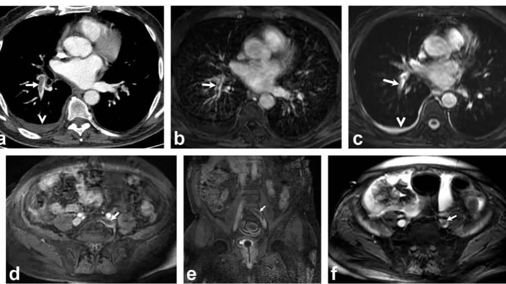 Akciğer damarındaki pıhtıların tanısında radyasyonsuz çözüm