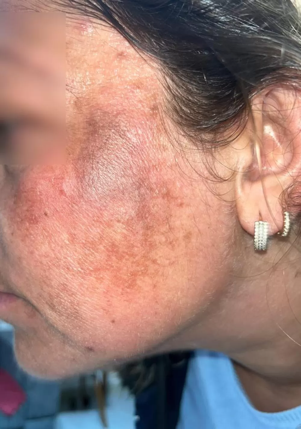 “Prenses Bakımı” Kabusa Döndü Yüzü Yandı