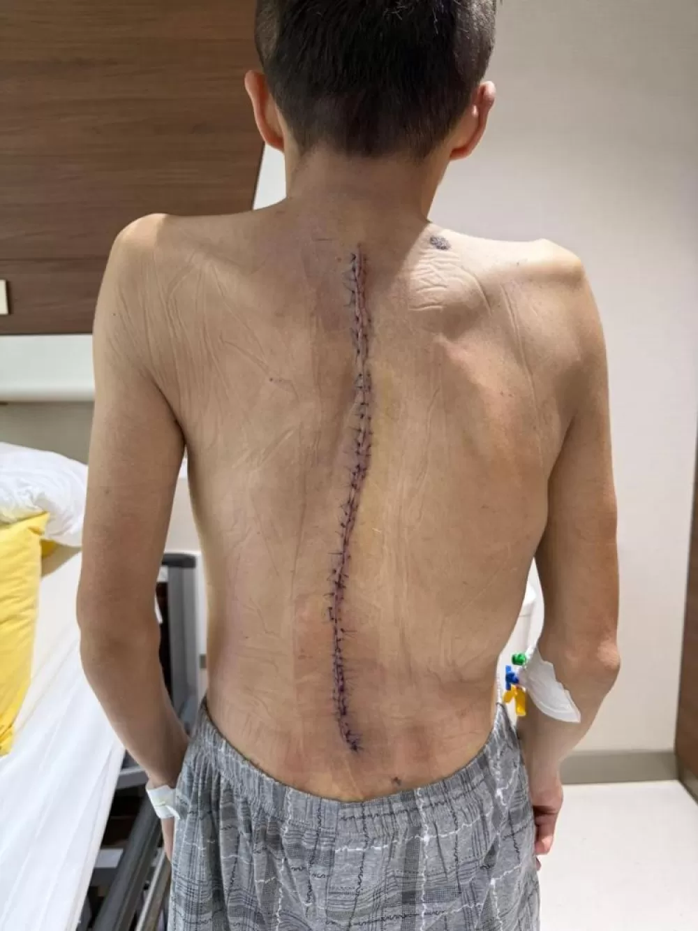 Skolyoz Hastası Genç Türkiye’de Sağlığına Kavuştu