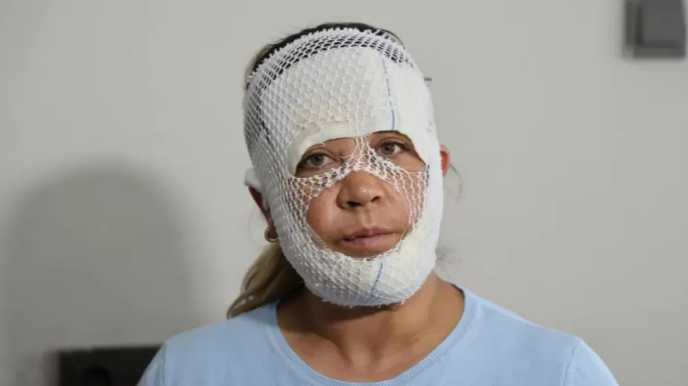 “Prenses Bakımı” Kabusa Döndü Yüzü Yandı